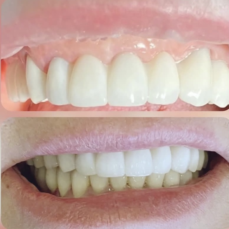 Имплантация зубов Алматы