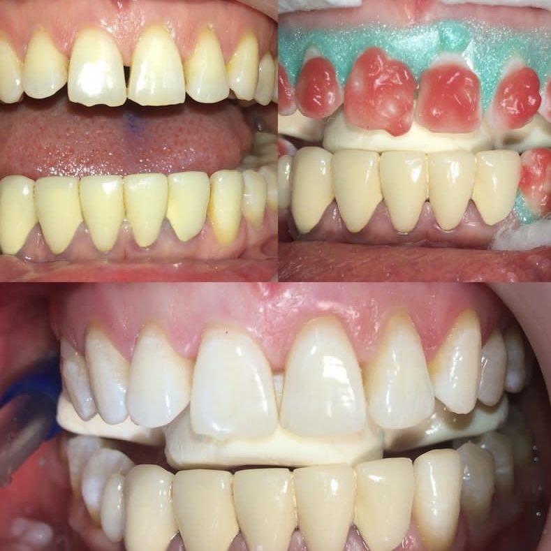 Имплантация зубов Алматы